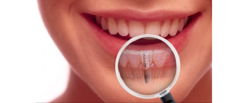 DentistaMED - clinica odontoiatrica Padova - Implantologia